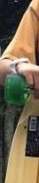 hypoperfusion,